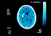 CT scan of cerebral (intracranial) haemorrhage