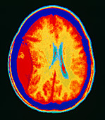 CT scan showing epidural haemorrhage