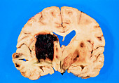 Section of brain showing intracerebral haemorrhage