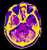 Coloured CT scan of the brain showing a stroke
