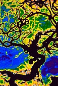 Coloured angiogram of cerebral aneurysm