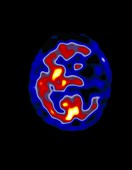Coloured PET scan of the brain of a stroke patient
