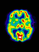 Coloured PET scan of the brain of a stroke patient