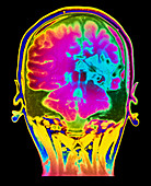 Colour MRI brain scan of arteriovenous malfunction