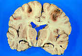 Section through brain with cerebral infarction