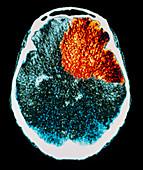 Stroke,CT scan