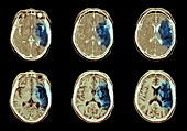 Stroke,CT scan