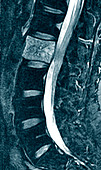 Vertebral haemangioma,MRI scan