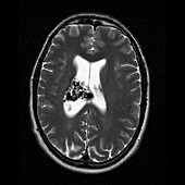 Brain arteriovenous malformation,MRI