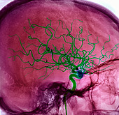 Haemorrhagic stroke damage,MRA scan