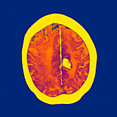 Brain haemorrhage,CT scan