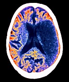 Stroke,CT brain scan