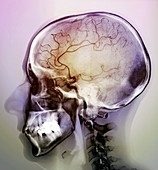 Stroke,angiogram