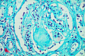 LM of glomerulus in a diabetic human kidney