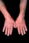 Dermatitis of hands