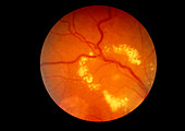 Fundus camera image of a diabetic retina