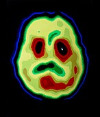 PET scan of brain in sub-cortical dementia