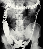 Barium X-ray showing colonic diverticula