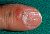 Dystrophic fingernail