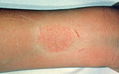 Contact dermatitis: wristwatch allergy