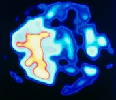 PET scan (cerebellar) of unknown type of dementia