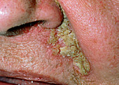 Close-up of seborrhoeic dermatitis on face