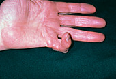 Dupuytrens contracture of little finger