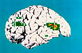 Coloured PET scan of brain showing depression