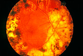 Fundoscopy of diabetic retinopathy eye treated