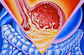 Artwork of dyspepsia (indigestion) in the stomach