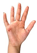 Girl's hand affected by contact dermatitis