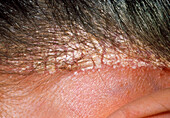 Severe dandruff on the scalp of 22 year old woman