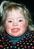 Two year old girl affected by Down's syndrome