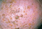 Seborrhoeic dermatitis on elderly person's scalp