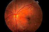 Retinal disorder in diabetes