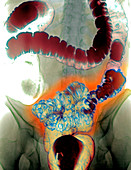 Colon diverticula,X-ray