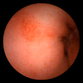 Inflammation of the duodenum,pill camera