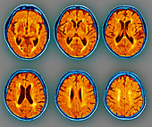 Dementia,MRI scans