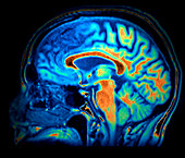 Frontal temporal dementia,MRI scan