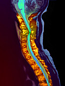 Inflamed spinal discs,MRI scan