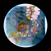 Intestinal diverticulosis,X-ray