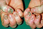 Eczema affecting the fingernails