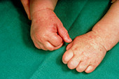 Reddening of an infants hand due to eczema