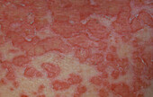 Eczema herpaticum rash