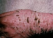 Gross lichenification in eczema