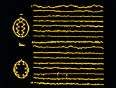 False-colour EEG showing focal epilepsy