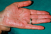 Discoid eczema: close-up of patient's hand