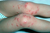 Bacteria-infected eczema rash on a child's legs