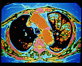 False-colour CT scan of a lung with emphysema