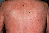 Erythema multiforme skin rash on back of male